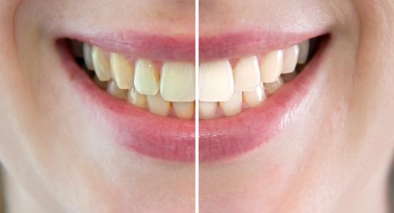 Cosa fare per avere denti più belli